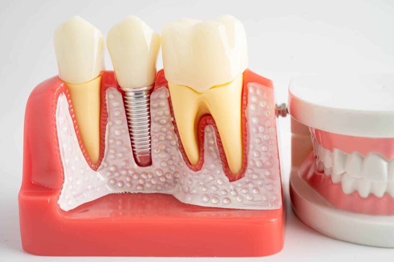 Dental Implants Ardmore